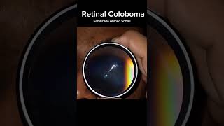 Retinal Coloboma Clinical View Captured with 20D Indirect Lens [upl. by Elleined926]