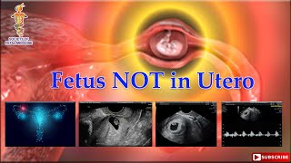 Fetus NOT in Utero [upl. by Letnom969]