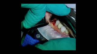 Cowhorn Forceps Tooth Extraction Video and Root Tip Removal [upl. by Oruntha]