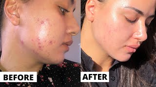 Tretinoin 3 month Update FAITH RESTORED  Tretinoin Before And After Results  DERMATICA [upl. by Shelah994]