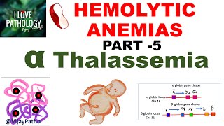 Hemolytic Anemias Part 5 Alpha Thalassemia Pathogenesis types Diagnosis amp Treatment [upl. by Celesta510]