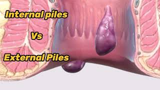 BAADI BAVASIR Vs Khooni Bawasir  Which are different types of Piles amp Haemorrhoids  Piles meaning [upl. by Adey]