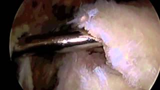 Arthroscopic Rotator Cuff Repair Surgery with SAD Dr Eric Janssen [upl. by Topper]