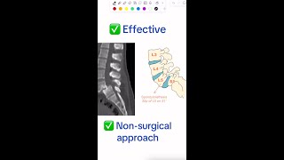 Diagnosis of the day  Spondylolisthesis [upl. by Heigl960]