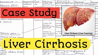 Case Study on Liver Cirrhosis  Case Presentation Nursing Care Plan nursingcriteria [upl. by Aihsrop]