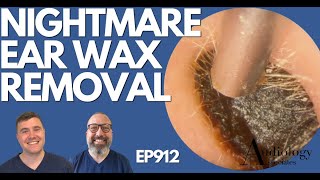 NIGHTMARE EAR WAX REMOVAL  EP912 [upl. by Alisa548]