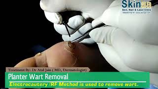 Plantar Wart Removal Treatment With Electrocautery or RF Method  Skinaa Clinic Jaipur [upl. by Trixy163]