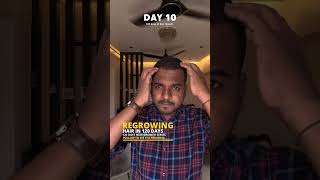 Using Derma roller and Minoxidil for Hair growth  Day 10 minoxidil dermaroller hairloss hair [upl. by Jandy]