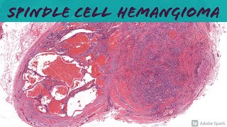 Spindle Cell Hemangioma 101 [upl. by Ellerd498]