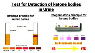 Chemical Examination of urine  Detection of ketone bodies in urine  Reagent strip  Rotheras Test [upl. by Pizor]