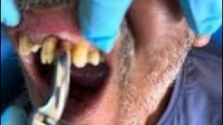 TEETH REMOVAL ☠️❤️teeth toothremoval teethcleaning toothless extracting teeth [upl. by Anead]