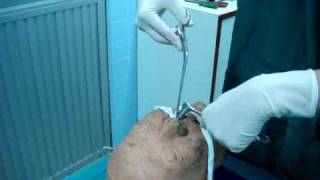 posterior nasal packing ENT PMK [upl. by Almeria]