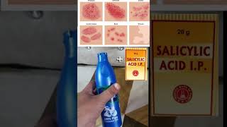 Fungal infection permanent treatment  Skin problems permanent treatment [upl. by Wunder]