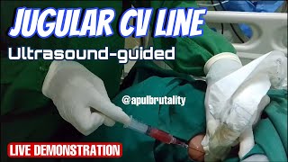 Jugular CV line ultrasound guided  central venous catheter CVC  vena dalam [upl. by Nagorb915]