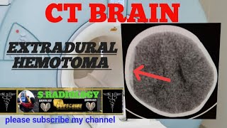 linear undisplaced fracture of parietal bone ct brain [upl. by Atteirneh18]