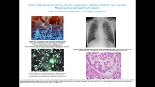 Human Respiratory Syncytial Virus Infection Epidemiology Pathology Treatment And Prevention [upl. by Derrej]