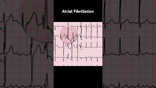 Atrial Fibrillation ECG Ashman phenomenon [upl. by Aluor]