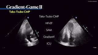 〖Echocardiography〗 Where is the gradient 💘 💫 [upl. by Laktasic]