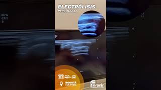 ELECTROLISIS PERCUTANEA COLOMBIA [upl. by Ahsinrac33]