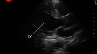 Video 6 Hyperdynamic LV contractility [upl. by Lema]