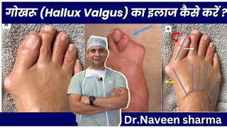 hallux valgus TREATMENT AT HOME [upl. by Ecille]