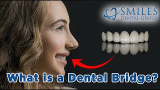 What is a Dental Bridge How is it Made 2021 [upl. by Lennard]