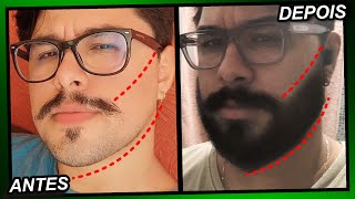 EVOLUÇÃO MINOXIDIL 1 ANO E 4 MESES Pant Foligain e Kirkland [upl. by Hewet]