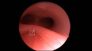 Laryngotracheal Cleft [upl. by Teodoor]