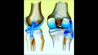 Posterolateral Corner Reconstruction  LaPrade Vs Arciero [upl. by Florina350]