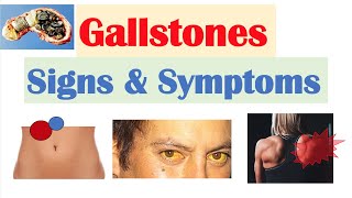 Gallstones Signs amp Symptoms Why They Occur  Cholecystitis Choledocholithiasis Cholangitis [upl. by Nelrac]