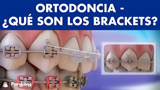 Ortodoncia – Brackets y otras partes del aparato dental © [upl. by Andrel737]