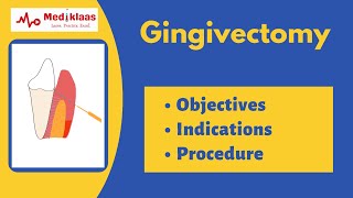 Gingivectomy l treatment of gingival overgrowth and gummy smile l Mediklaas [upl. by Dlanod]