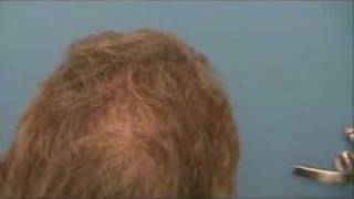 Hair Transplant  Results  7218 Grafts  Hasson amp Wong [upl. by Aprilette421]