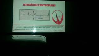 Taquiarritmias parte 1 [upl. by Westberg]