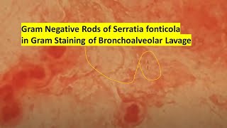 Gram Negative Rods of Serratia fonticola in Gram Staining of Bronchoalveolar Lavage [upl. by Dorrej]