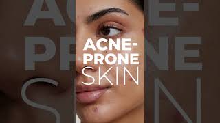 AcneProne Skin Care Routine5 easy Tips to followshorts acnetreatment acnetipsskincareroutine [upl. by Rehpotsirh221]