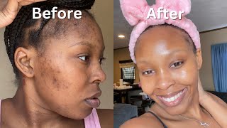 How I Cleared My Acne  Dark Spots  Hyperpigmentation for good in 1 month NO ACCUTANE VIDEO PROOF [upl. by Nagiam]