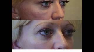 Dissolving Under Eye Fillers  Kami Parsa MD in Beverly Hills CA [upl. by Zeret]