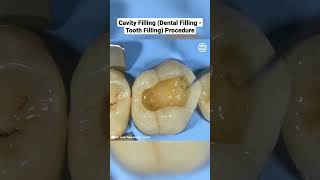 Cavity Filling Dental Filling  Tooth Filling Procedure Cusp BuildUp of a Molar [upl. by Illene]