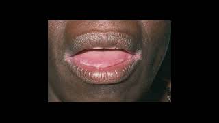 Angular Cheilitis  Symptoms and Causes  Diagnosis  Treatment  Prevention healthcare health [upl. by Ynnor]