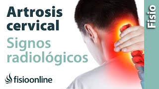 Artrosis cervical  Signos radiológicos [upl. by Rednasyl]