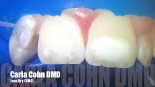 Smooth Surface Enamel Treatment Using Icon with Dr Cohn [upl. by Eical]