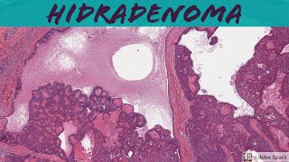 Nodular Hidradenoma Acrospiroma 5Minute Pathology Pearls [upl. by Jermyn]