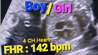 heartbeat ultrasound sound  heart rate boygirl  Fetal doppler heartbeat sound  fetal heart rate [upl. by Ainomar]