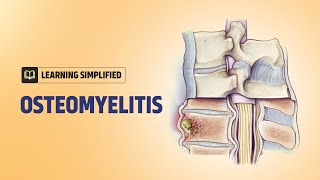 Bone Infection  Causes Risk Factors amp Treatment with Animation [upl. by Sairahcaz]