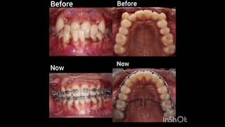 Progress in orthodontic treatment [upl. by Gaulin]