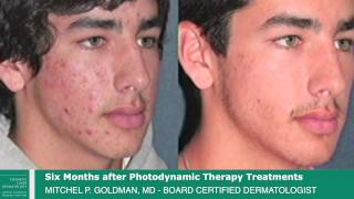 Dr Goldman Patient Testimonial  Photodynamic Therapy Laser Treatment for Acne [upl. by Galligan]