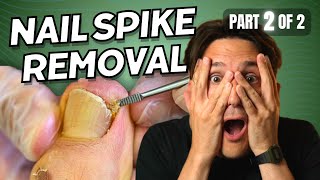 Ingrown Toenail Spike Removal part 2 of 2 [upl. by Adnolay]