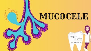 ORAL MUCOCELE  MUCOUS EXTRAVASATION  HOW IT FORMS  CLINICAL FEATURES  HISTOLOGY  TREATMENT [upl. by Iblok]