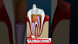 Root Canal Treatment amp Tooth AbscessRoot shorts viralvideo viralshorts [upl. by Nrojb]